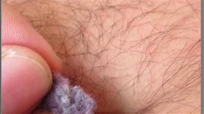 ما اسباب الخيوط التى تنتجها السرة وتتجمع بها على شكل وبر