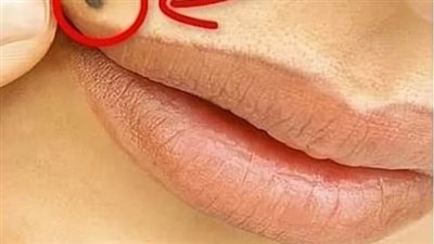 هل تعلم ماذا تعني وجود الشامات علي جسم الانسان ؟