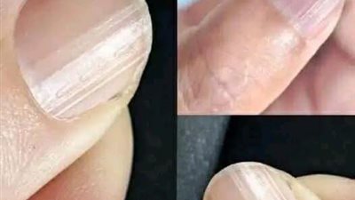 وجود أظافر مخططة قد يعني أن جسمك