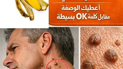 الثآليل على الجلد: العدو الصامت الذي يعاني منه كثير من الناس، وقليلون يعرفون كيف يعالجونه طبيعيًا.