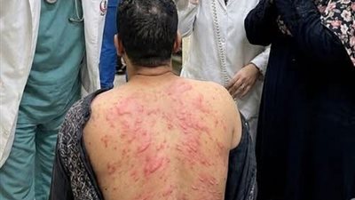 وجدتُ ثلاثين بقعة حمراء على ظهر زوجي تشبه بيض الحشرات